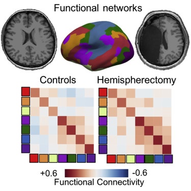 результаты гемисферэктомии